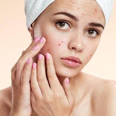 Acne: cause e rimedi