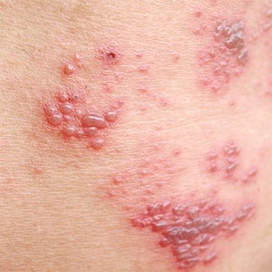 Infezioni micotiche: cosa è la Tinea Cruris?