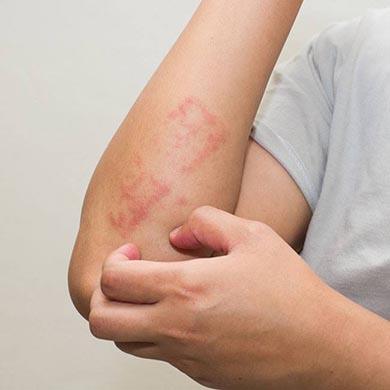 Come trattare l'Eczema