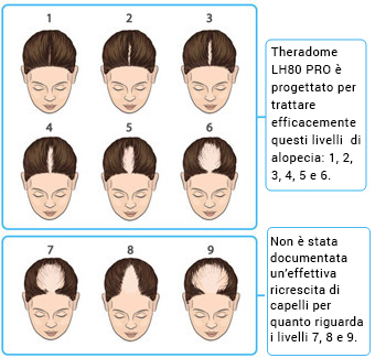fasi di calvizie curabili con theradome
